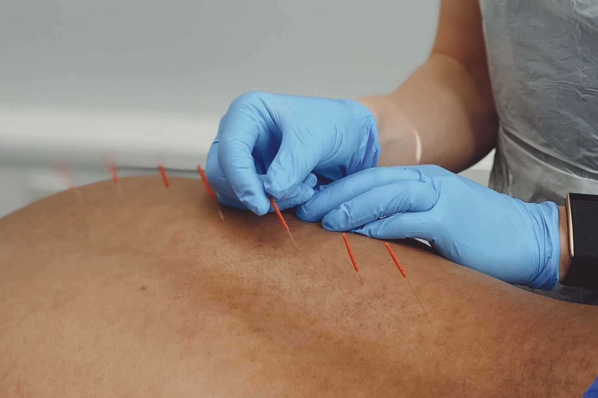 Medical Acupuncture (Dry Needling)